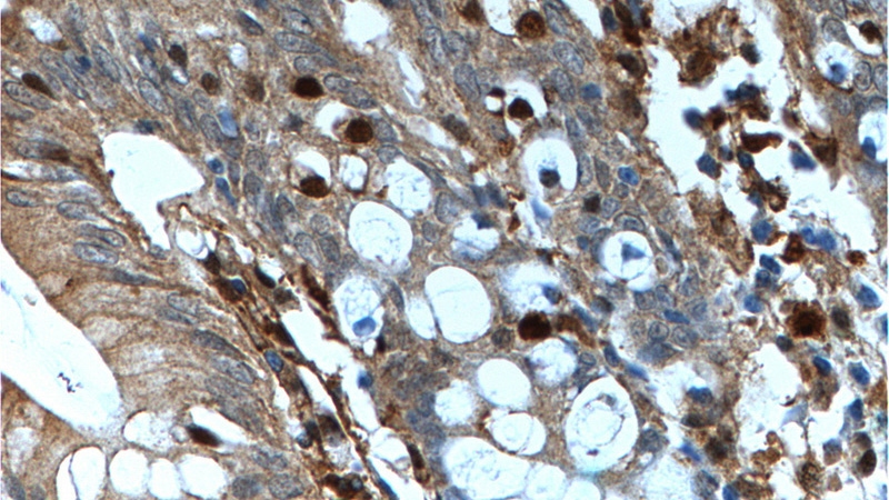 Immunohistochemistry of paraffin-embedded human colon tissue slide using Catalog No:107294(Gelsolin Antibody) at dilution of 1:200 (under 40x lens).