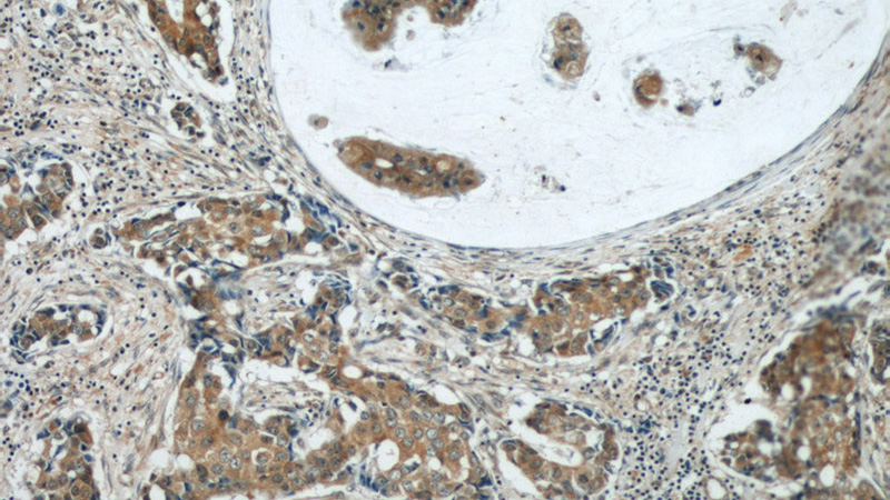 Immunohistochemical of paraffin-embedded human breast cancer using Catalog No:107899(AEG-1 antibody) at dilution of 1:50 (under 10x lens)
