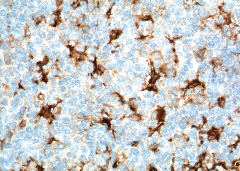 Immunohistochemistry of paraffin-embedded human tonsillitis tissue slide using Catalog No:107205(Fascin Antibody) at dilution of 1:600 (under 40x lens). Heat mediated antigen retrieved with Tris-EDTA buffer(pH9).