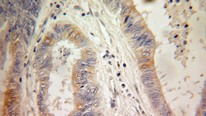 Immunohistochemical of paraffin-embedded human colon cancer using Catalog No:110419(EXTL3 antibody) at dilution of 1:100 (under 25x lens)