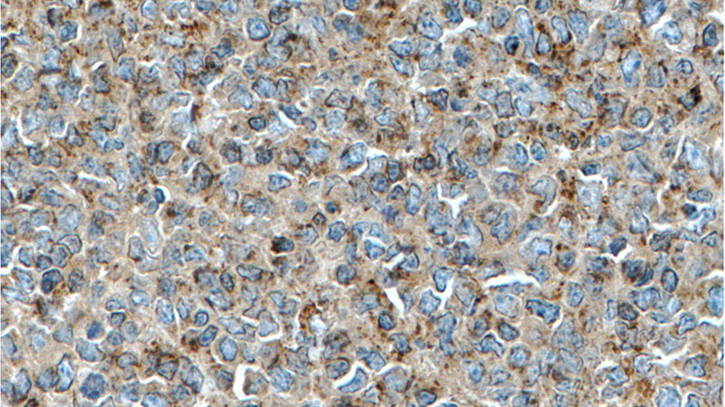 Immunohistochemistry of paraffin-embedded human tonsillitis tissue slide using (PD-L1/CD274 Antibody) at dilution of 1:500 (under 40x lens). heat mediated antigen retrieved with Tris-EDTA buffer(pH9).