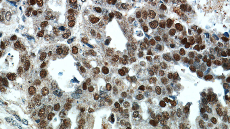 Immunohistochemical of paraffin-embedded human ovary tumor using Catalog No:116258(TP53 antibody) at dilution of 1:100 (under 40x lens)