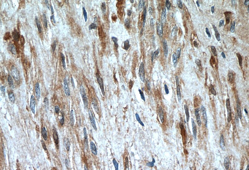 Immunohistochemistry of paraffin-embedded human hysteromyoma tissue slide using Catalog No:113530(OXTR Antibody) at dilution of 1:50 (under 40x lens)
