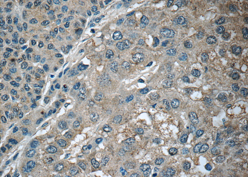 Immunohistochemistry of paraffin-embedded human liver cancer tissue slide using Catalog No:109637(CXCL12 Antibody) at dilution of 1:50 (under 40x lens)