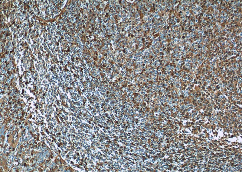 Immunohistochemistry of paraffin-embedded human tonsillitis tissue slide using Catalog No:111722(IGHG4 Antibody) at dilution of 1:50 (under 10x lens)