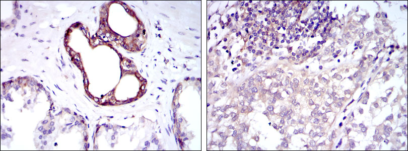 Immunohistochemical analysis of paraffin-embedded prostate tissues (left) and bladder cancer tissues (right) using NFKB1 mouse mAb with DAB staining.