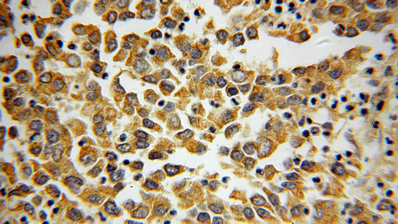 Immunohistochemical of paraffin-embedded human pancreas cancer using Catalog No:107477(PLOD3 antibody) at dilution of 1:100 (under 40x lens)