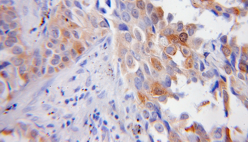Immunohistochemical of paraffin-embedded human lung cancer using Catalog No:110661(FBLN5 antibody) at dilution of 1:50 (under 10x lens)