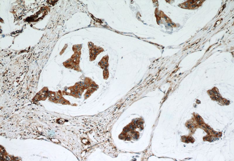 Immunohistochemical of paraffin-embedded human breast cancer using Catalog No:113309(NOTCH3 antibody) at dilution of 1:50 (under 10x lens)