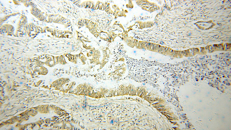 Immunohistochemical of paraffin-embedded human pancreas cancer using Catalog No:113415(OPTN antibody) at dilution of 1:50 (under 10x lens)