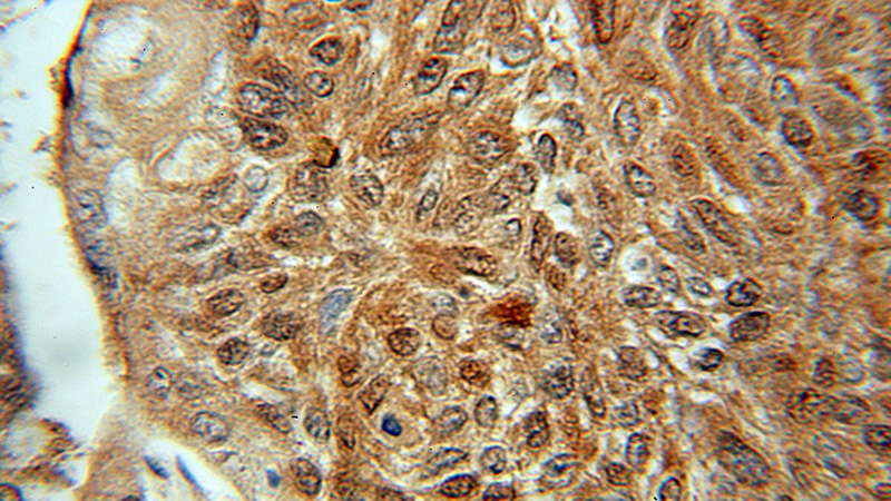 Immunohistochemical of paraffin-embedded human lung cancer using Catalog No:115176(SGTA antibody) at dilution of 1:50 (under 10x lens)