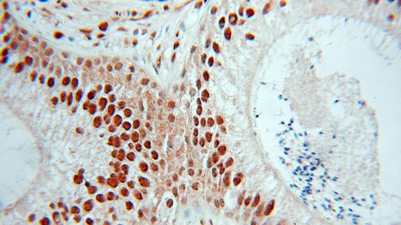 Immunohistochemical of paraffin-embedded human prostate cancer using Catalog No:109624(CTBP1 antibody) at dilution of 1:50 (under 40x lens)
