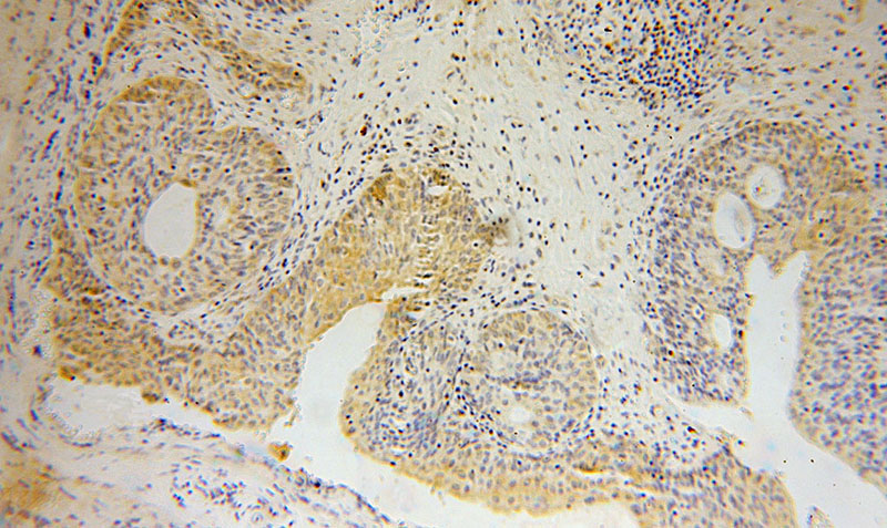Immunohistochemical of paraffin-embedded human colon cancer using Catalog No:112777(MTHFD1L antibody) at dilution of 1:100 (under 10x lens)