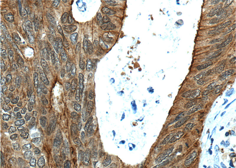 Immunohistochemistry of paraffin-embedded human colon cancer tissue slide using Catalog No:107539(VIL1 Antibody) at dilution of 1:500 (under 40x lens). heat mediated antigen retrieved with Tris-EDTA buffer(pH9).