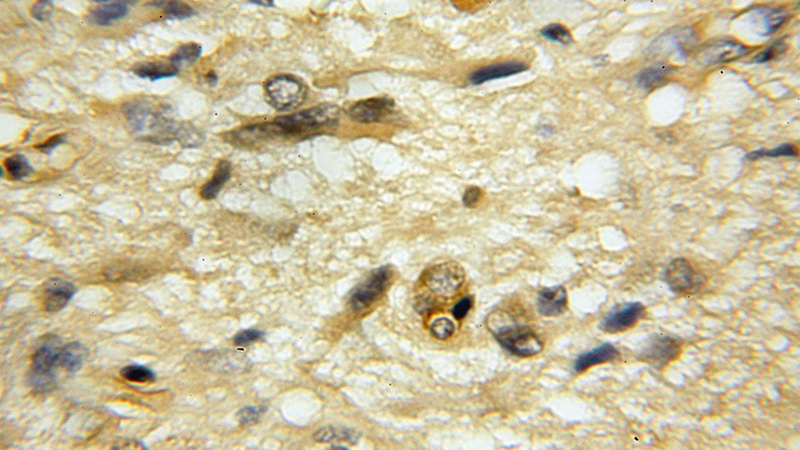 Immunohistochemical of paraffin-embedded human medulloblastoma using Catalog No:116606(USP33 antibody) at dilution of 1:50 (under 10x lens)