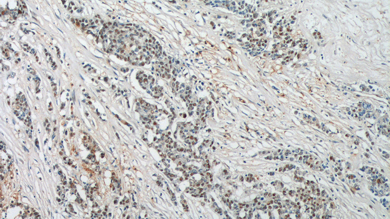 Immunohistochemistry of paraffin-embedded human colon cancer tissue slide using Catalog No:115042(SAE1 Antibody) at dilution of 1:200 (under 10x lens).