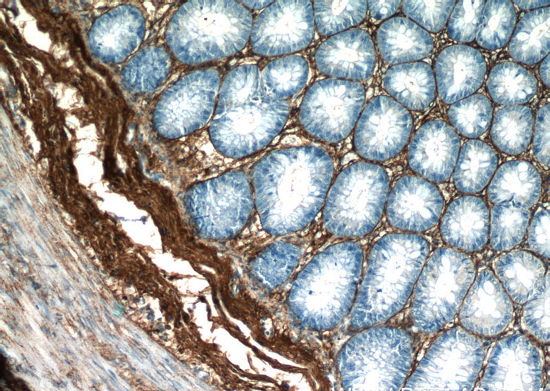 Immunohistochemistry of paraffin-embedded human colon slide using Catalog No:109377(COL3A1 Antibody) at dilution of 1:50 (under 10x lens)
