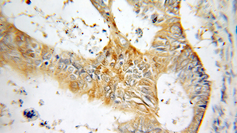 Immunohistochemical of paraffin-embedded human colon cancer using Catalog No:107657(CSTB antibody) at dilution of 1:100 (under 10x lens)