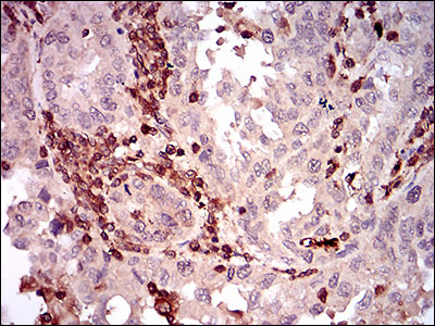 Fig5: Immunohistochemical analysis of paraffin-embedded human endometrial cancer tissue using anti-CD68 antibody. Counter stained with hematoxylin.