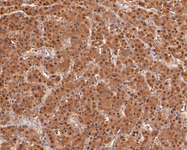 Fig3:; Immunohistochemical analysis of paraffin-embedded human liver carcinoma tissue using anti-TMX4 antibody. The section was pre-treated using heat mediated antigen retrieval with Tris-EDTA buffer (pH 8.0-8.4) for 20 minutes.The tissues were blocked in 5% BSA for 30 minutes at room temperature, washed with ddH; 2; O and PBS, and then probed with the primary antibody ( 1/50) for 30 minutes at room temperature. The detection was performed using an HRP conjugated compact polymer system. DAB was used as the chromogen. Tissues were counterstained with hematoxylin and mounted with DPX.