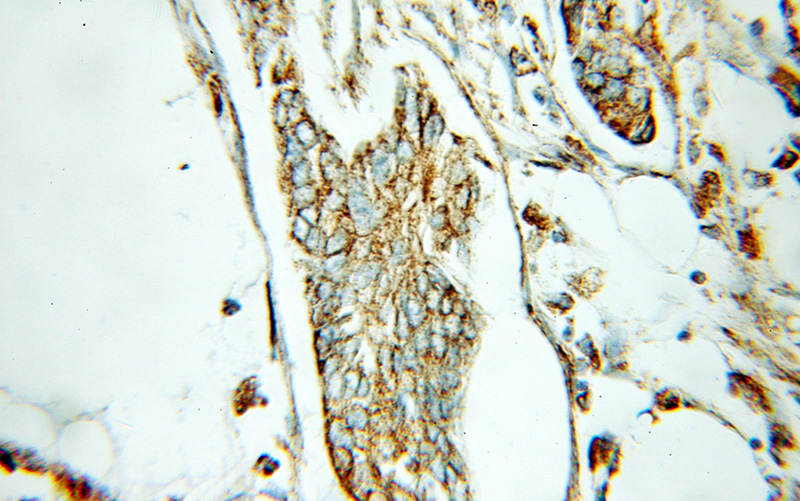 Immunohistochemical of paraffin-embedded human pancreas cancer using Catalog No:110292(ECH1 antibody) at dilution of 1:100 (under 10x lens)