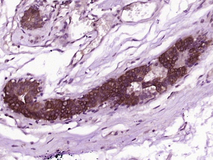 Fig2: Paraformaldehyde-fixed, paraffin embedded (Human breast cancer); Antigen retrieval by boiling in sodium citrate buffer (pH6.0) for 15min; Block endogenous peroxidase by 3% hydrogen peroxide for 20 minutes; Blocking buffer (normal goat serum) at 37℃ for 30min; Antibody incubation with (CWH43) Polyclonal Antibody, Unconjugated at 1:400 overnight at 4℃, followed by operating according to SP Kit(Rabbit) (sp-0023) instructions and DAB staining.