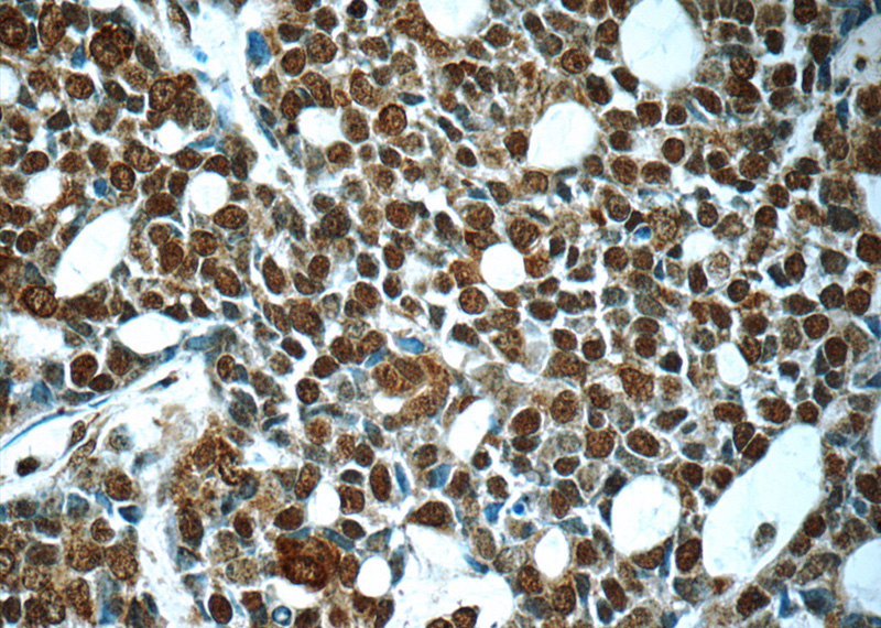 Immunohistochemistry of paraffin-embedded human cervical cancer tissue slide using Catalog No:107478(PMS2 Antibody) at dilution of 1:50 (under 40x lens)