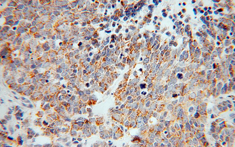 Immunohistochemical of paraffin-embedded human lung cancer using Catalog No:117258(SLC30A7 antibody) at dilution of 1:100 (under 40x lens)