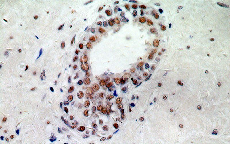Immunohistochemical of paraffin-embedded human prostate cancer using Catalog No:113040(NCL antibody) at dilution of 1:100 (under 40x lens)