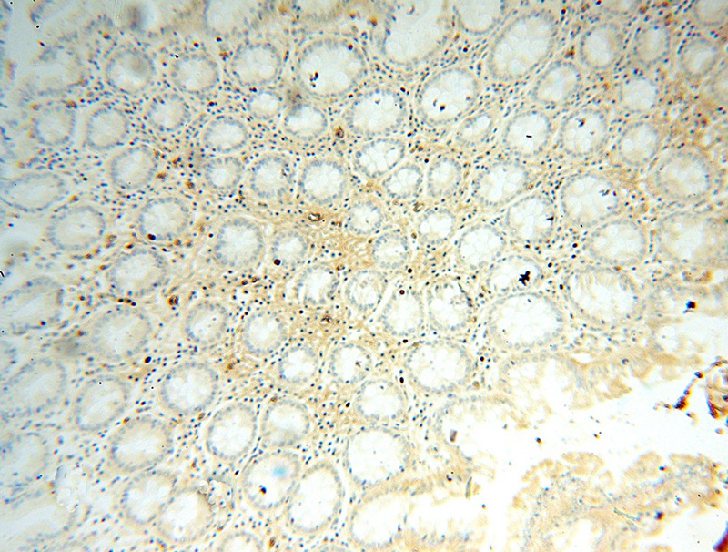 Immunohistochemical of paraffin-embedded human colon cancer using Catalog No:111085(GYPA antibody) at dilution of 1:50 (under 10x lens)