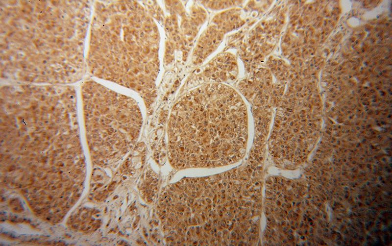 Immunohistochemical of paraffin-embedded human liver cancer using Catalog No:109817(D2HGDH antibody) at dilution of 1:50 (under 10x lens)