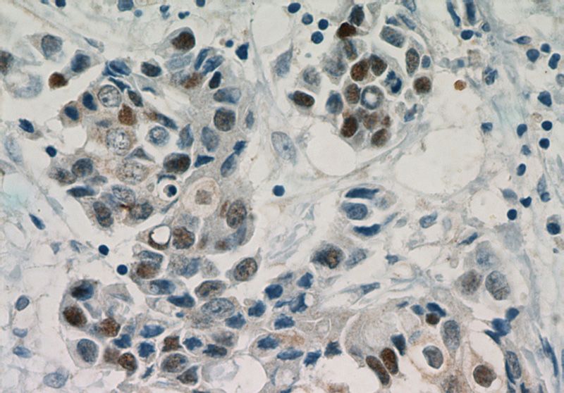 Immunohistochemical of paraffin-embedded human breast cancer using Catalog No:110397(ESR1 antibody) at dilution of 1:25 (under 40x lens). Heat mediated antigen retrieved with Citric acid buffer, pH6.0
