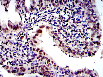 Immunohistochemical analysis of paraffin-embedded intima cancer tissues using PSMB8 mouse mAb with DAB staining.