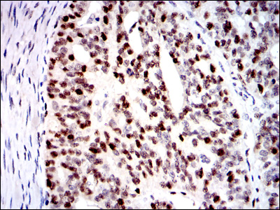 Immunohistochemical analysis of paraffin-embedded ovarian cancer tissues using MCM2 mouse mAb with DAB staining.