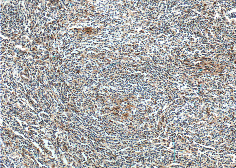 Immunohistochemistry of paraffin-embedded human lymphoma tissue slide using Catalog No:110687(FLI1 Antibody) at dilution of 1:200 (under 10x lens). heat mediated antigen retrieved with Tris-EDTA buffer(pH9).