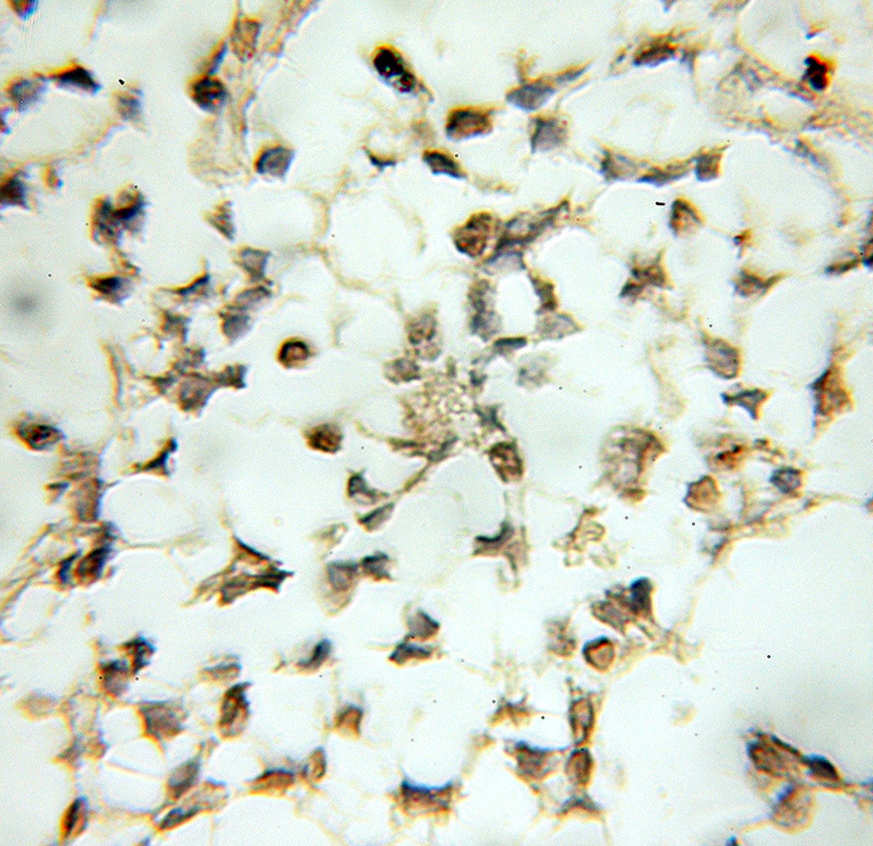 Immunohistochemical of paraffin-embedded human gliomas using Catalog No:113446(NR4A2 antibody) at dilution of 1:50 (under 10x lens)