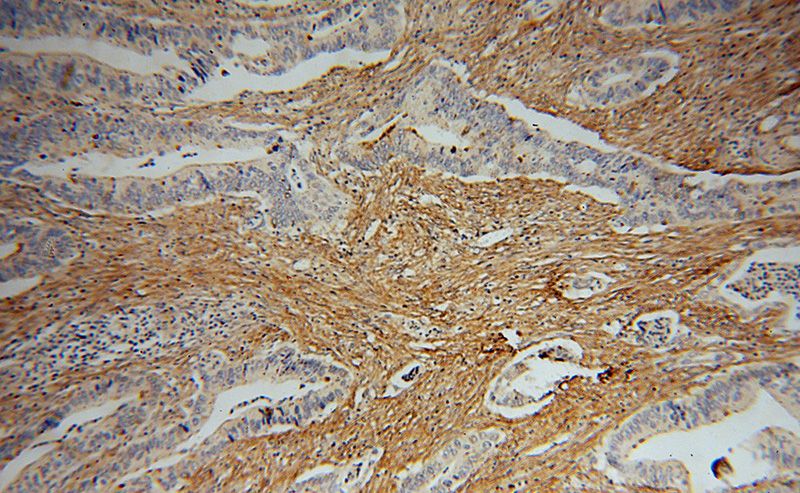 Immunohistochemical of paraffin-embedded human colon cancer using Catalog No:110659(FN1 antibody) at dilution of 1:50 (under 10x lens)