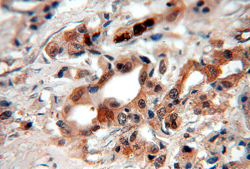Immunohistochemical of paraffin-embedded human breast cancer using Catalog No:114966(S100A9 antibody) at dilution of 1:100 (under 40x lens)