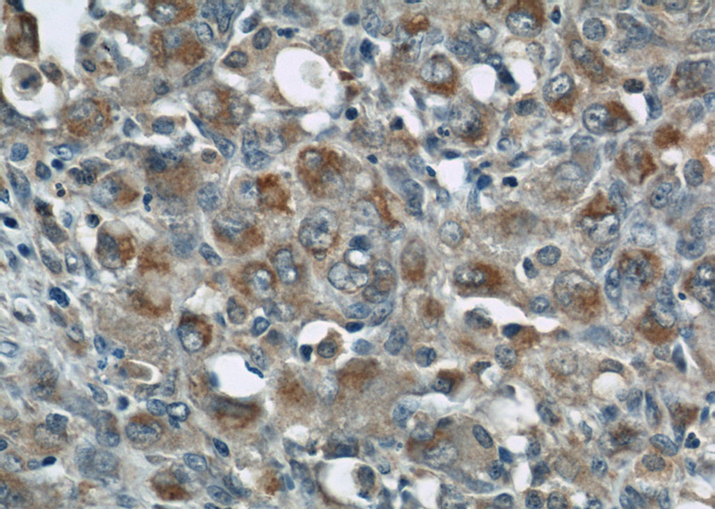 Immunohistochemical of paraffin-embedded human lymphoma using Catalog No:116905(ZAP70 antibody) at dilution of 1:50 (under 40x lens)