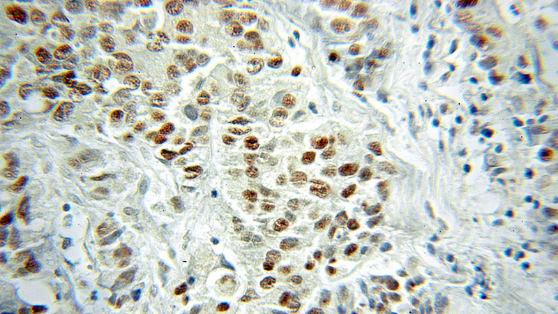 Immunohistochemical of paraffin-embedded human prostate cancer using Catalog No:116744(VGLL1 antibody) at dilution of 1:50 (under 10x lens)