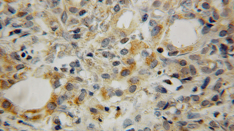 Immunohistochemical of paraffin-embedded human pancreas cancer using Catalog No:112576(MEA1 antibody) at dilution of 1:50 (under 40x lens)