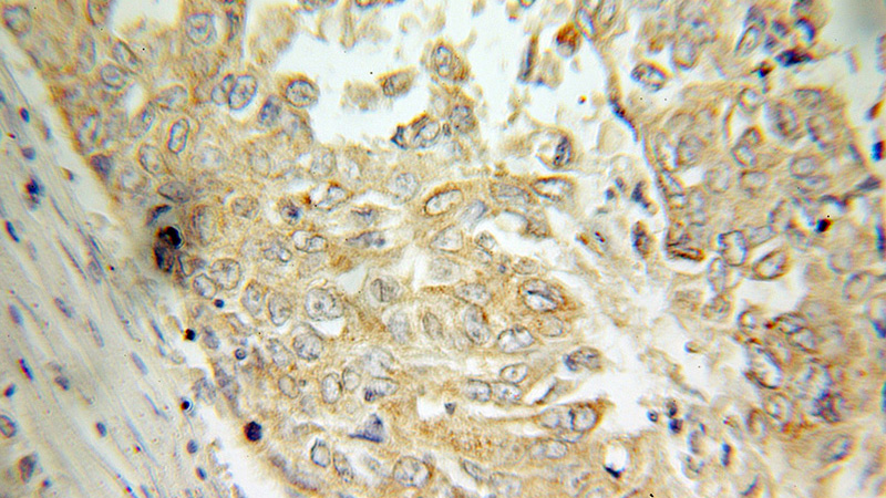 Immunohistochemical of paraffin-embedded human lung cancer using Catalog No:116208(TPMT antibody) at dilution of 1:100 (under 40x lens)