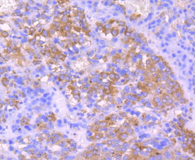 Fig6:; Immunohistochemical analysis of paraffin-embedded human liver carcinoma tissue using anti-IGF2 antibody. The section was pre-treated using heat mediated antigen retrieval with Tris-EDTA buffer (pH 9.0) for 20 minutes.The tissues were blocked in 1% BSA for 30 minutes at room temperature, washed with ddH; 2; O and PBS, and then probed with the primary antibody ( 1/50) for 30 minutes at room temperature. The detection was performed using an HRP conjugated compact polymer system. DAB was used as the chromogen. Tissues were counterstained with hematoxylin and mounted with DPX.