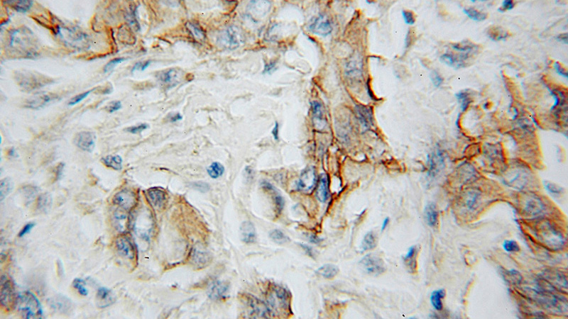 Immunohistochemical of paraffin-embedded human pancreas cancer using Catalog No:111746(IL5RA antibody) at dilution of 1:100 (under 10x lens)