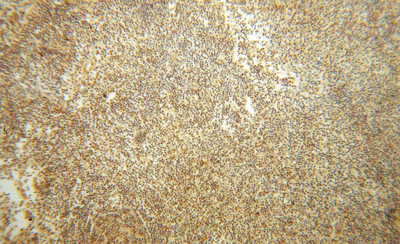 Immunohistochemical of paraffin-embedded human lymphoma using Catalog No:107275(IFITM1 antibody) at dilution of 1:50 (under 10x lens)