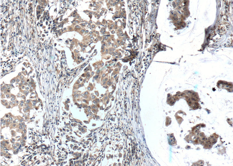 Immunohistochemistry of paraffin-embedded human breast cancer tissue slide using Catalog No:115749(SURVIVIN Antibody) at dilution of 1:200 (under 10x lens). heat mediated antigen retrieved with Tris-EDTA buffer(pH9).