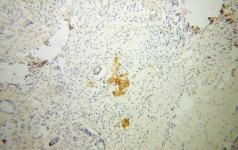 Immunohistochemical of paraffin-embedded human pancreas cancer using Catalog No:111002(GNG4 antibody) at dilution of 1:100 (under 10x lens)