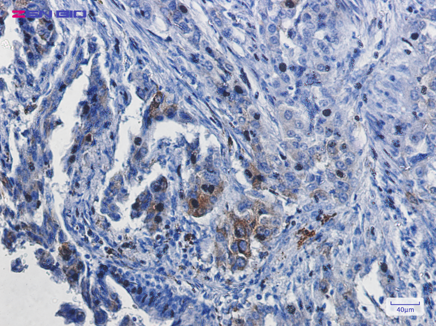Immunohistochemistry of Heme Oxygenase 1 in paraffin-embedded Human lung cancer tissue using Heme Oxygenase 1 Rabbit pAb at dilution 1/50
