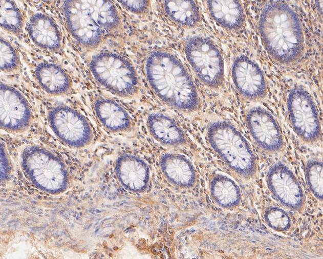 Fig4:; Immunohistochemical analysis of paraffin-embedded human colon tissue using anti-TREM2 antibody. The section was pre-treated using heat mediated antigen retrieval with Tris-EDTA buffer (pH 8.0-8.4) for 20 minutes.The tissues were blocked in 5% BSA for 30 minutes at room temperature, washed with ddH; 2; O and PBS, and then probed with the primary antibody ( 1/50) for 30 minutes at room temperature. The detection was performed using an HRP conjugated compact polymer system. DAB was used as the chromogen. Tissues were counterstained with hematoxylin and mounted with DPX.