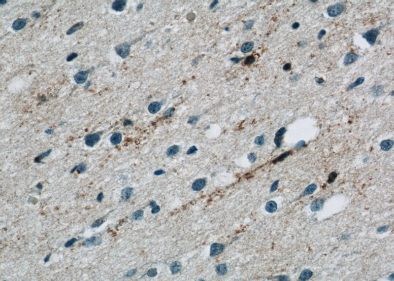 Immunohistochemistry of paraffin-embedded human brain tissue slide using Catalog No:113209(NPC1 Antibody) at dilution of 1:50 (under 40x lens)